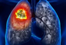 В Бургас започва Седмица на отворените врати и безплатни прегледи за туберкулоза